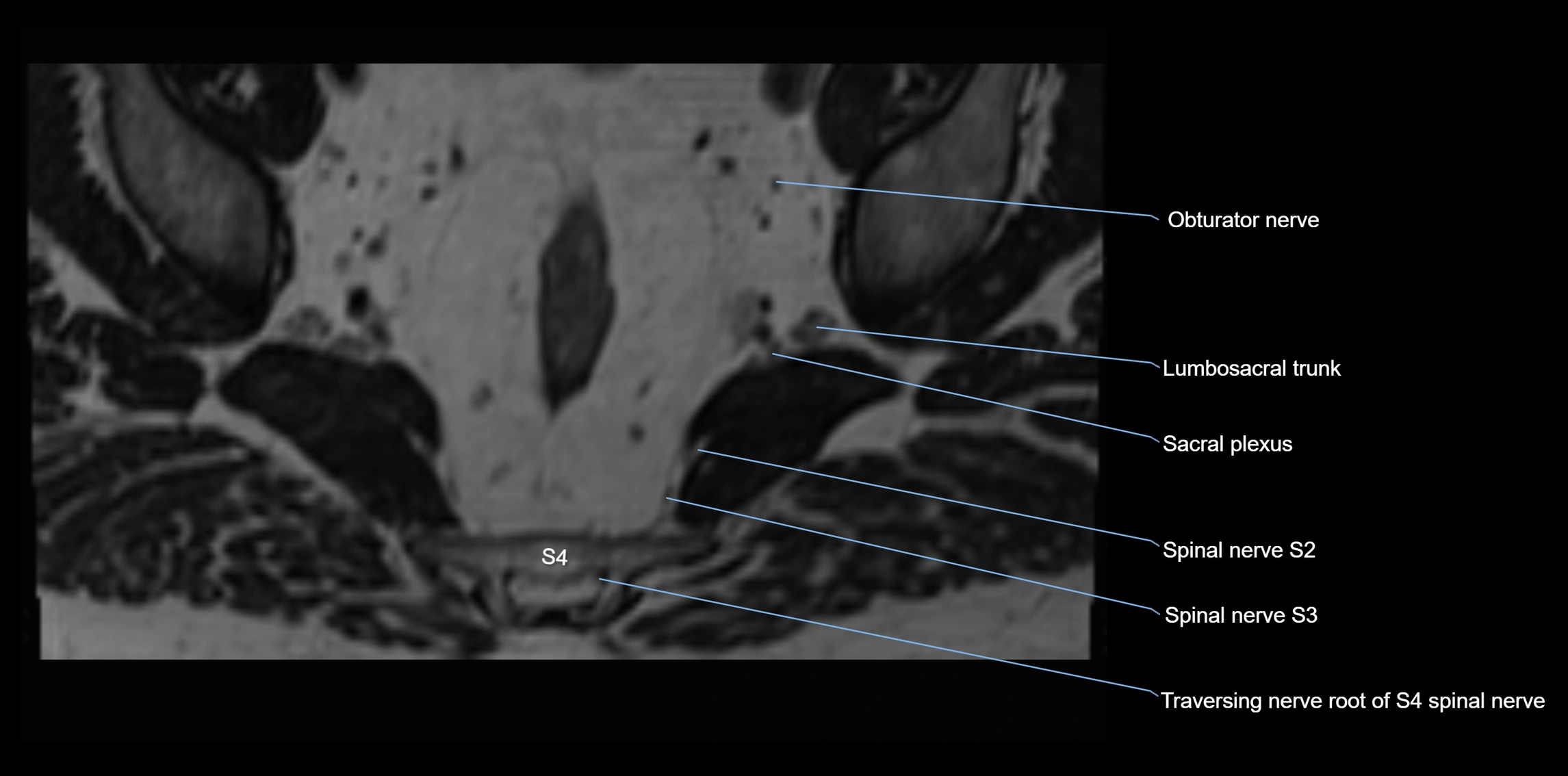 MR lumbosacral plexus axial cross sectional anatomy 3T  radiology  image-img-1008001-00100.webp